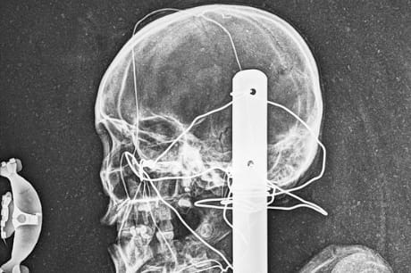 An X-ray of the mummy’s head.