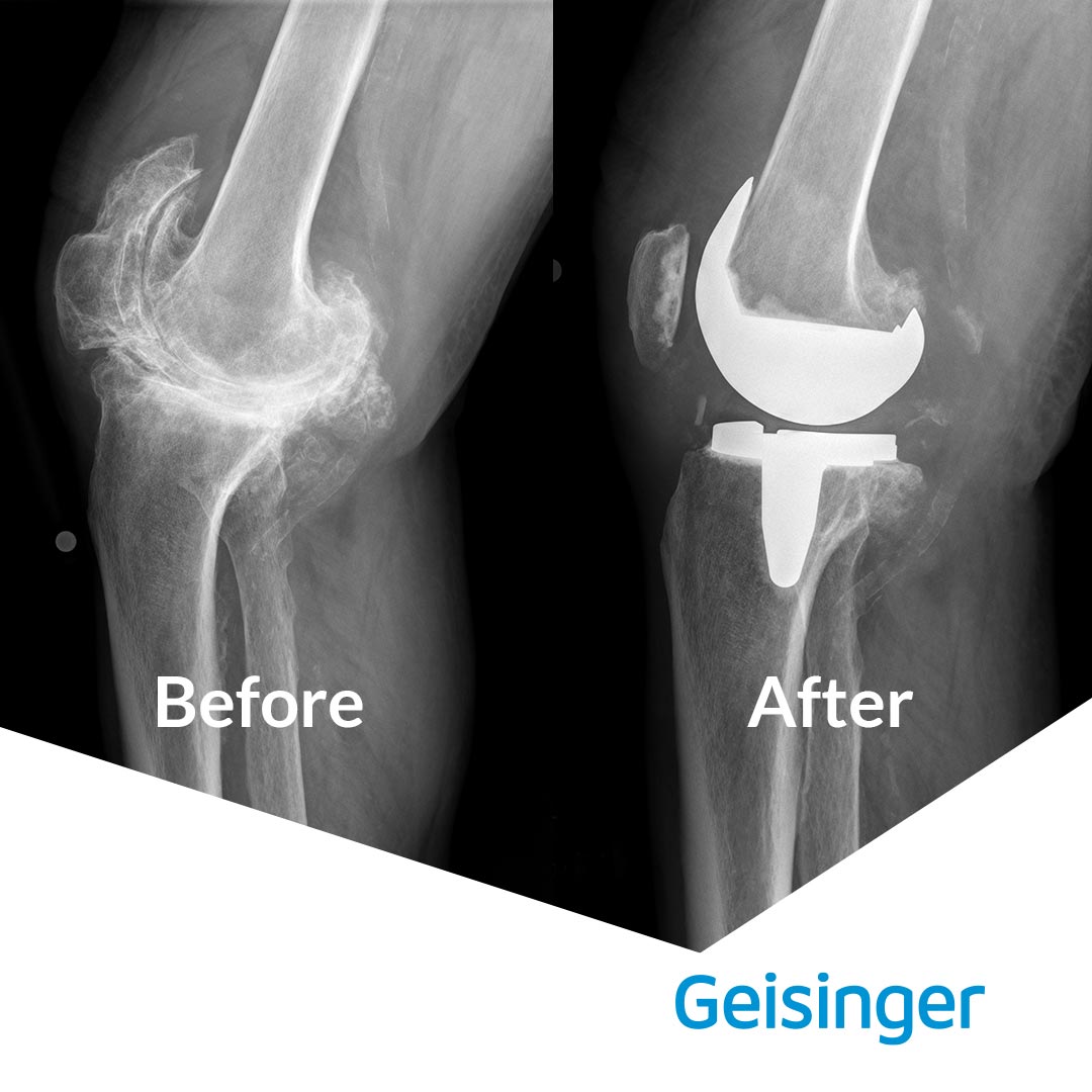 Knee Replacement Images-Before and After.