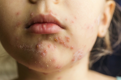 Child with disease around her mouth.