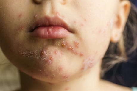 Child with disease around her mouth.