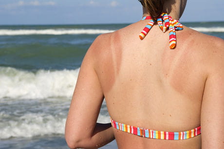 A young woman with sunburn on her back at the beach.