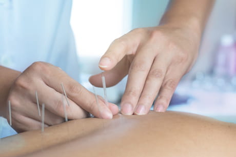 Acupuncture needles in skin