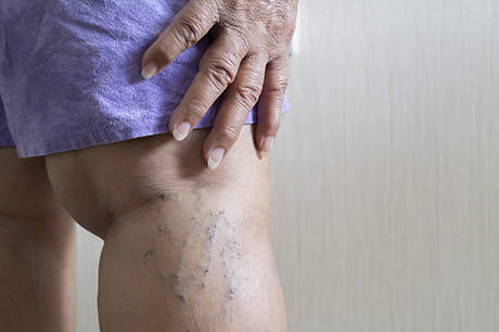 A persons leg with varicose veins