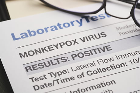 Lab results for Monkey Pox