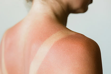A woman with sunburn on her shoulders.