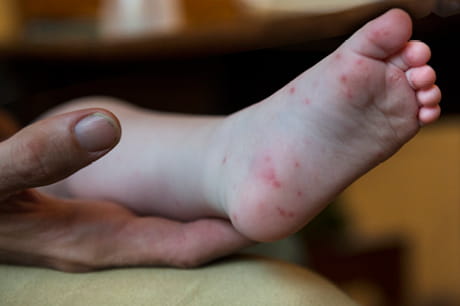 A small child's foot with hand-foot-and-mouth disease