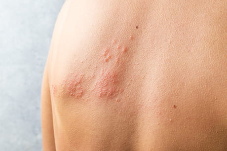 person with shingles on back