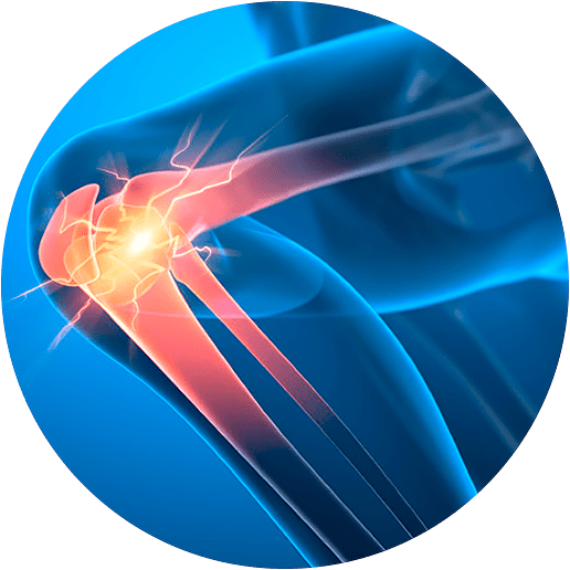 A stylized illustration of a knee injury.