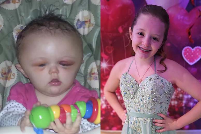 A young Miracle Kid patient is pictured in contrasting stages of life.