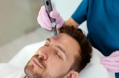 A man getting microneedling treatment. 