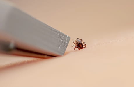 attempting to remove a tick using tweezers