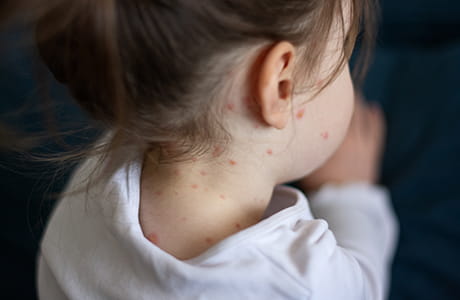 young girl with measles